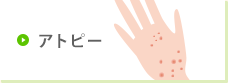アトピー