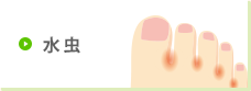 水虫