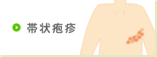 帯状疱疹